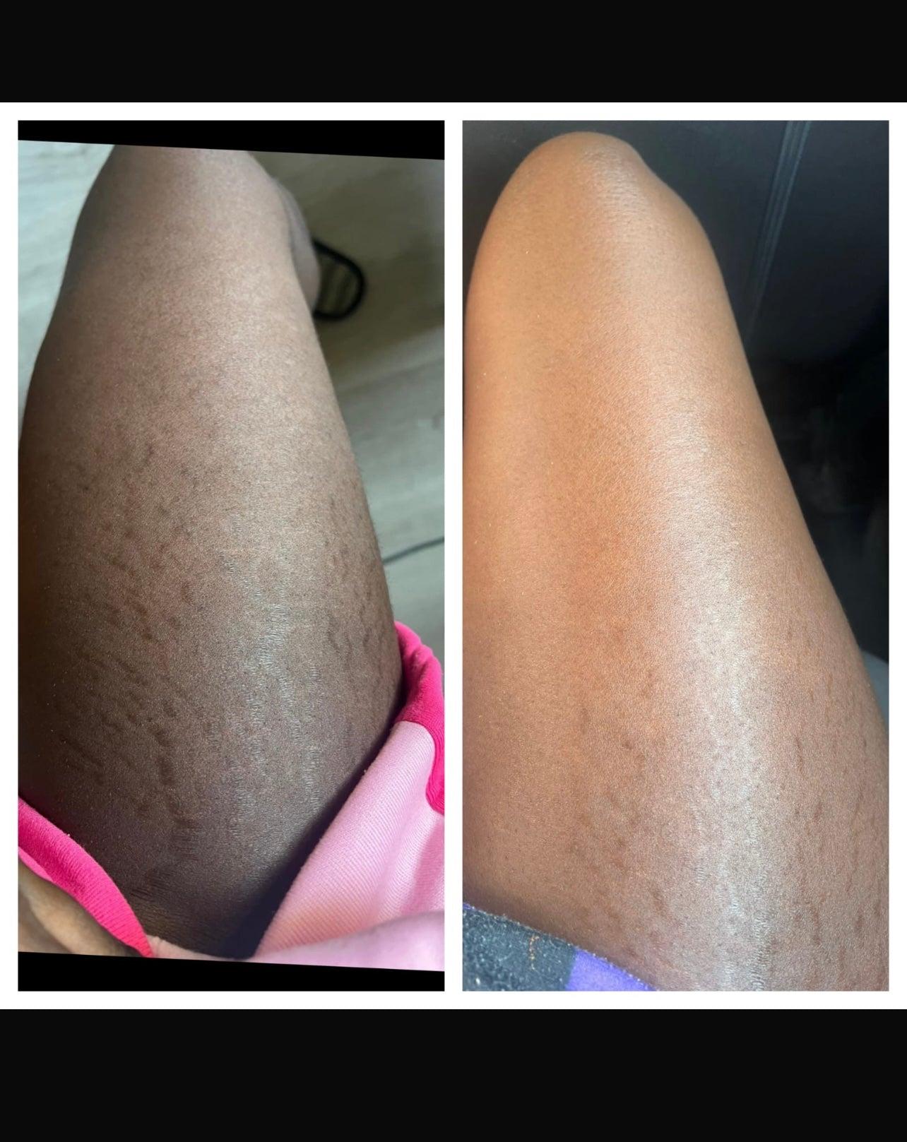 Body magic by khalifa
Stretch marks remover oil