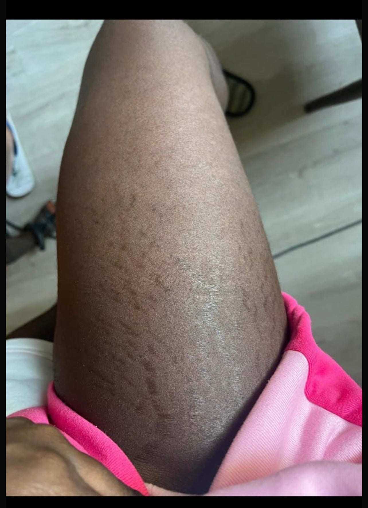 Body magic by khalifa
Stretch marks remover oil